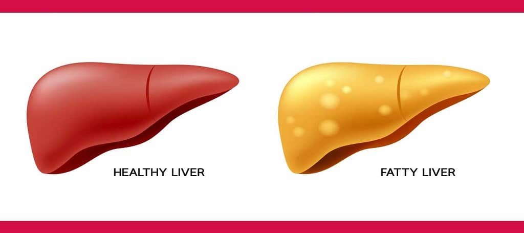 Fatty liver best treatment in Ayurveda